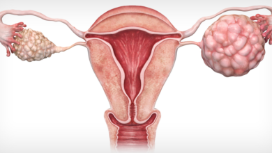 ovarian cancer illustration l